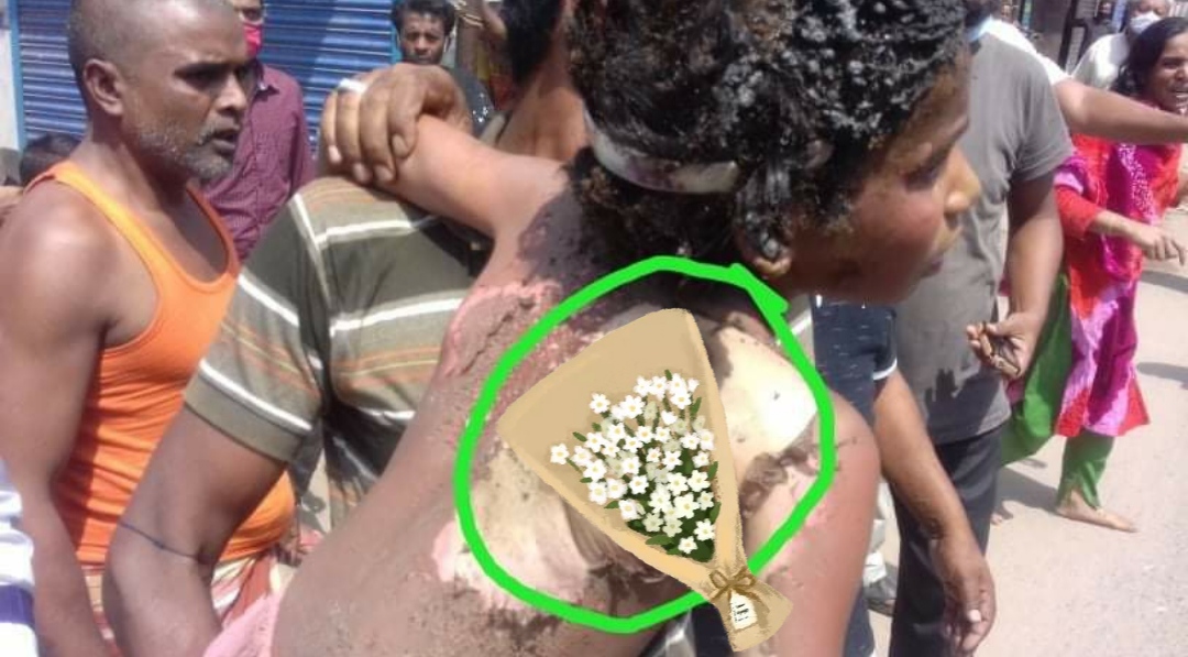 গাজীপুরে বিদ্যুৎ স্পৃষ্টে পুড়ে গেল শিশুর শরীর